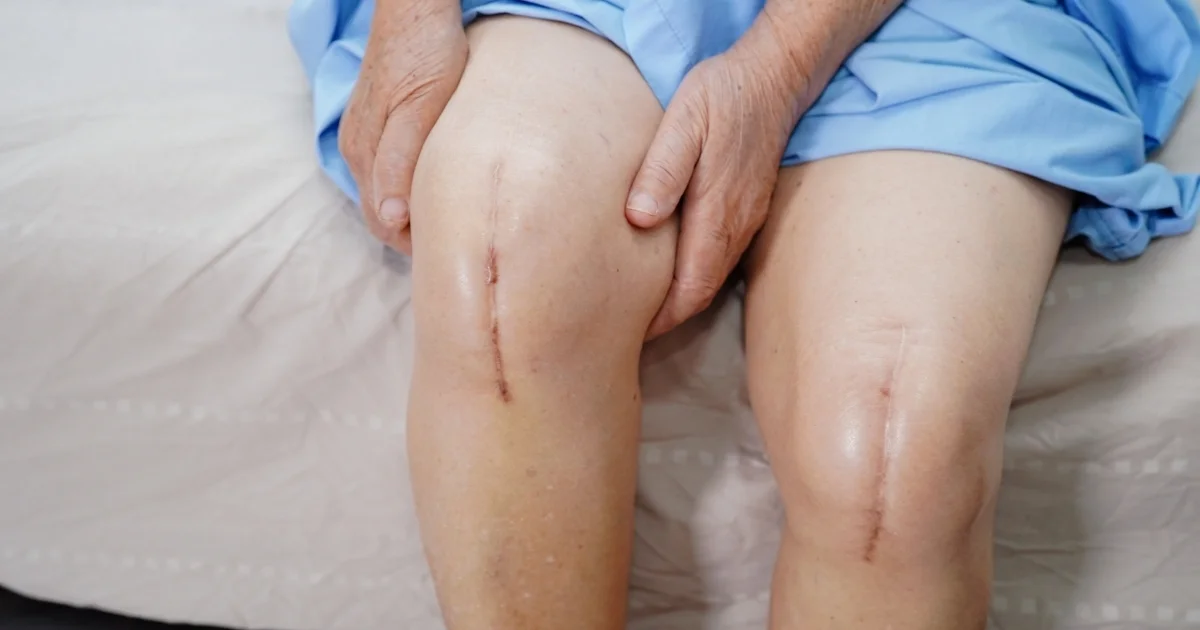 Knee Replacement Surgery